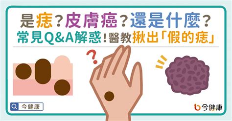 為何會長痣|是痣？還是皮膚癌？皮膚科醫師教你揪出「假的痣」，。